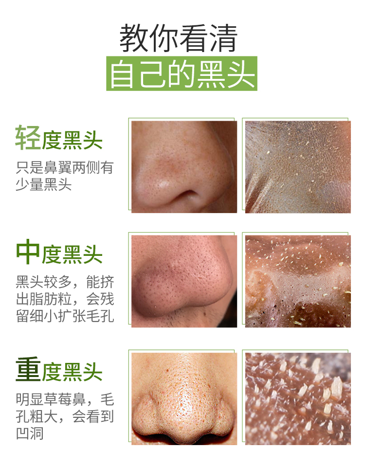 最新去黑頭教程視頻匯總，科技助力美麗重塑，黑頭無憂新篇章